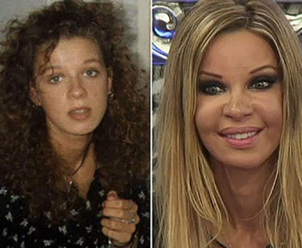 整容波折?整容变毁容的15个实在案例(附对于比图片)