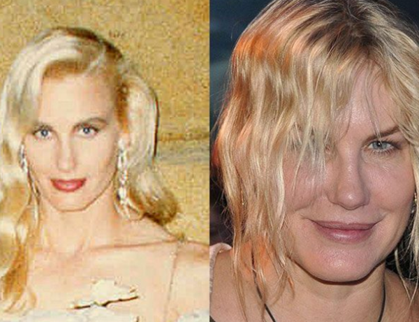 整容波折?整容变毁容的15个实在案例(附对于比图片)