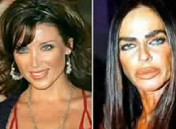 整容波折?整容变毁容的15个实在案例(附对于比图片)