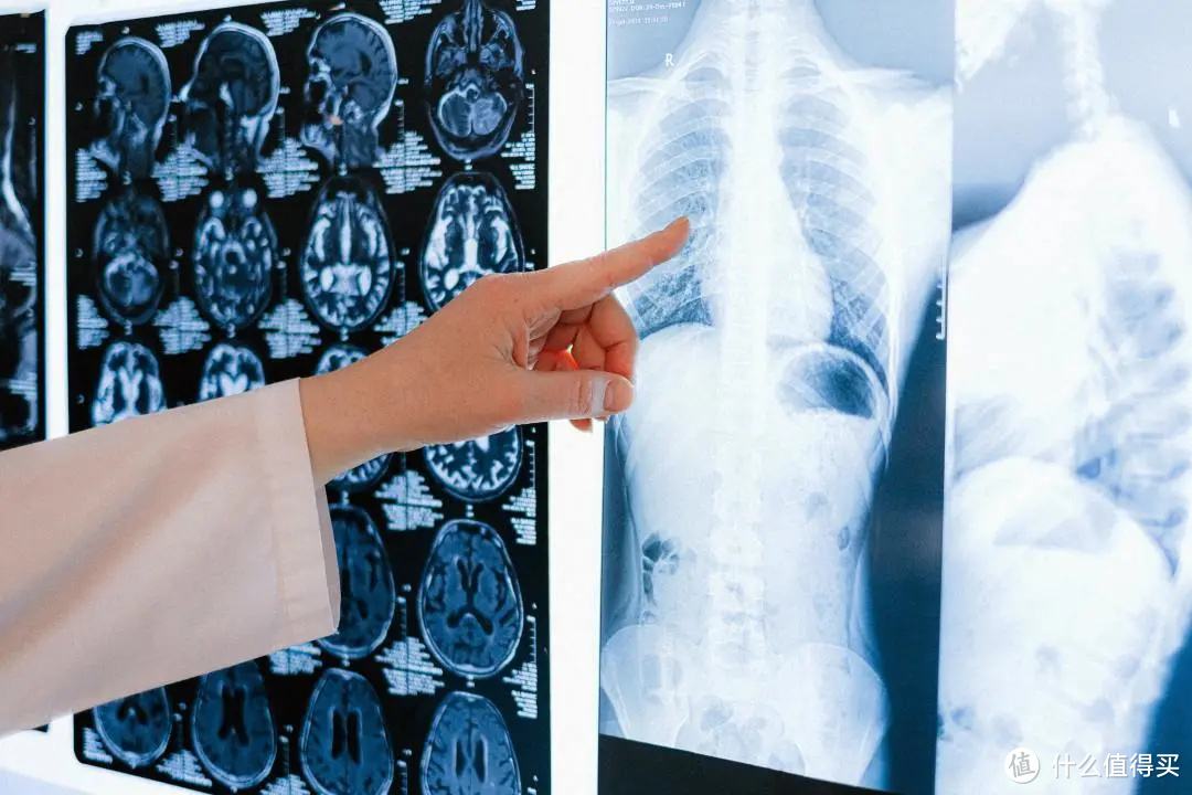 肺部CT需求暴增 检出率约10%-20%