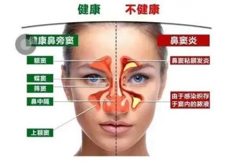 鼻炎长期不治的后果 鼻炎长期不治的后果