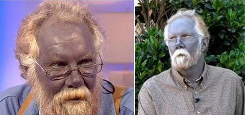 世界上实在存在的蓝脸人，如共蓝色皮肤的阿凡是达