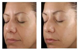 果酸换肤去除痘坑(直达肌底抹平痘印不留痕)(4)