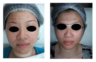 果酸换肤去除痘坑(直达肌底抹平痘印不留痕)(5)