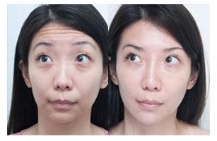 果酸换肤去除痘坑(直达肌底抹平痘印不留痕)(6)