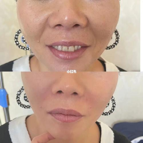 法令纹填充方法大全(如何改善法令纹)