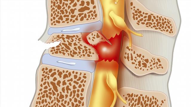 先天性脊髓栓系综合征严重不（新生儿的罕见病）(10)