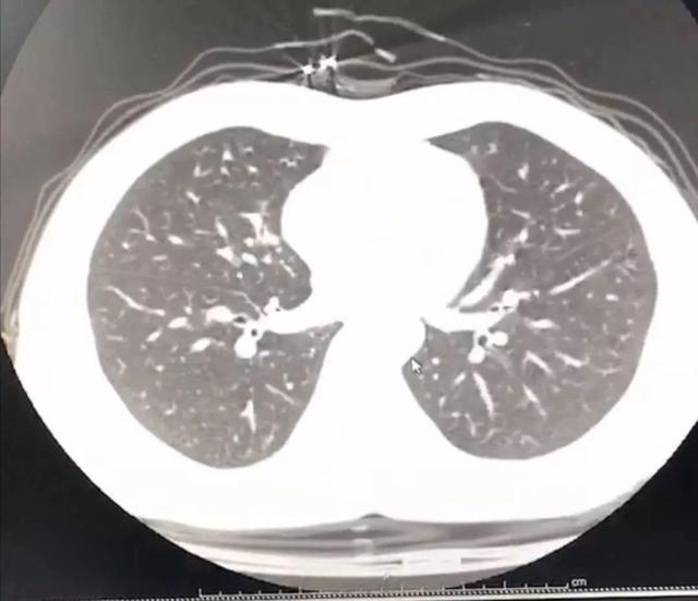 如何判断自己感染新型肺炎了（疑似感染新型肺炎）(11)