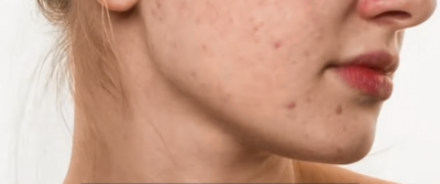 ​怎么去除痘疤 快速消除痘痘痘疤