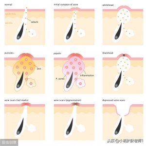 ​怎么去除毛孔里的脏东西（怎么清除毛孔里的脏东西？）