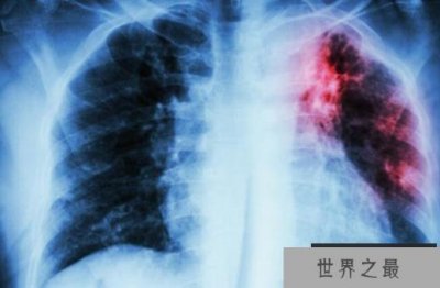 ​世界五大绝症 健康的身体比什么都重要