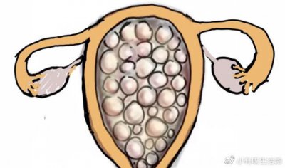 ​葡萄胎图片 高度警惕