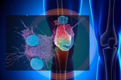​中国发现 人干细胞年轻因子有助于骨关节炎治疗