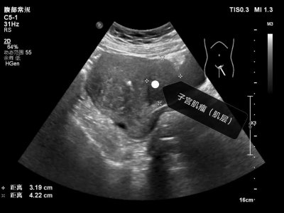 ​子宫肌瘤是什么病（女性朋友们关心的子宫肌瘤究竟是咋回事）