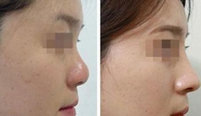 ​鼻子大鼻翼宽怎么办(鼻子鼻翼很宽怎么办)