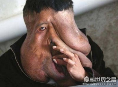 ​世界上最大的“像面人”，黄春才(面部肿瘤达30余斤)