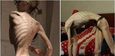 ​世界上最瘦的人多少斤