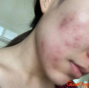 ​十大烂脸激素护肤品排行榜国产 容易烂脸的护肤品成分