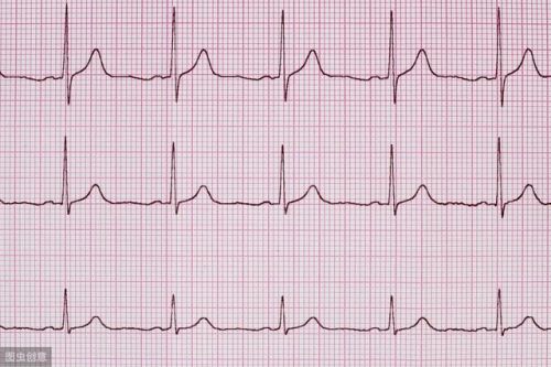 窦性心动过速是什么意思严重吗(窦性心动过速是病吗)-第1张图片-