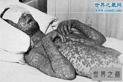 ​世界十大恐怖流行病，已夺走数亿人的生命